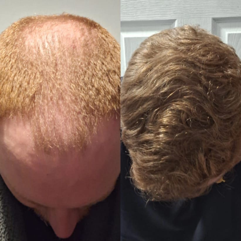 prp for hair loss treatment Alex James Clinic Manchester
