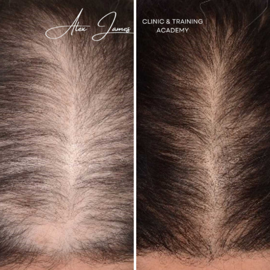 PRP for thinning hair Alex James Clinic in Rossendale