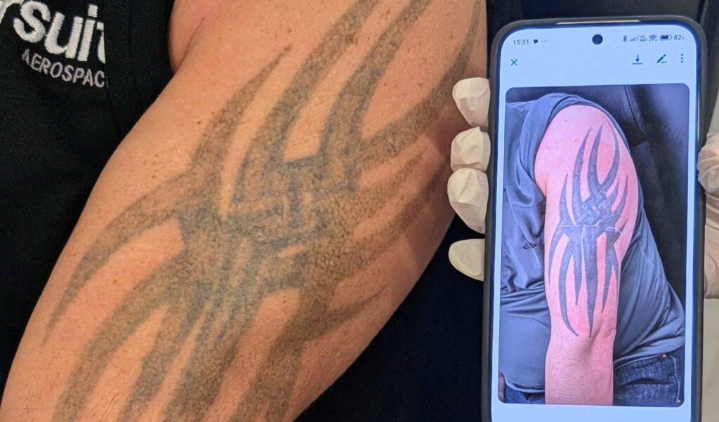 laser tattoo removal Alex James Clinic North West