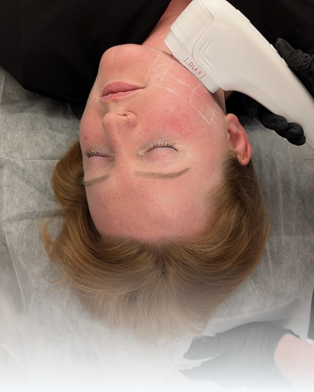 hifu skin tightening treatment Alex James Clinic Manchester