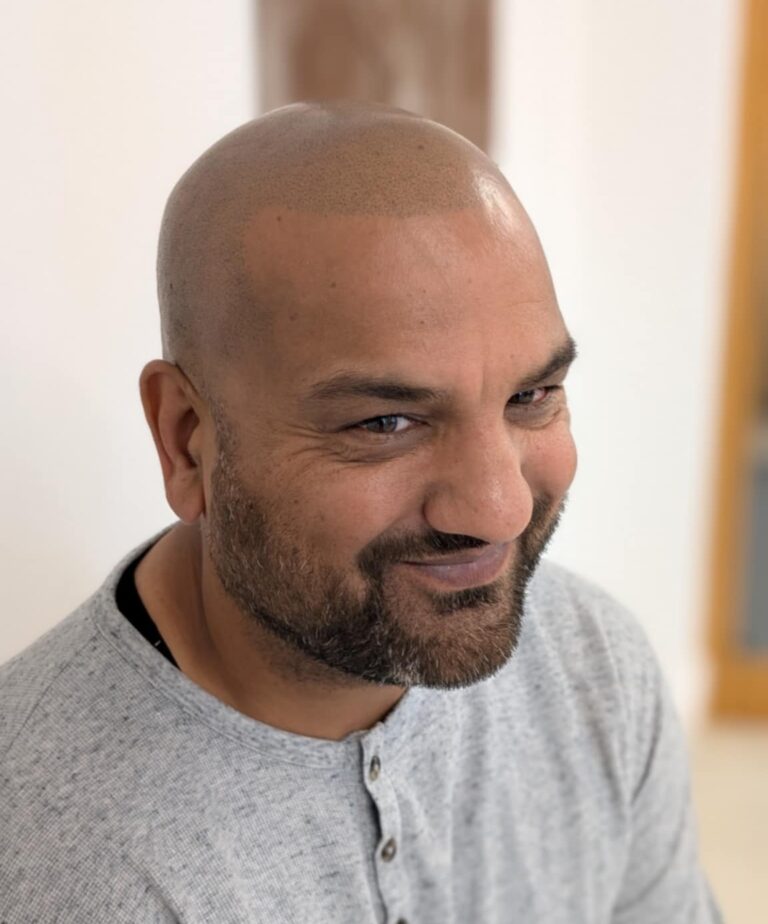 SMP treatment at Alex James Clinic Rossendale