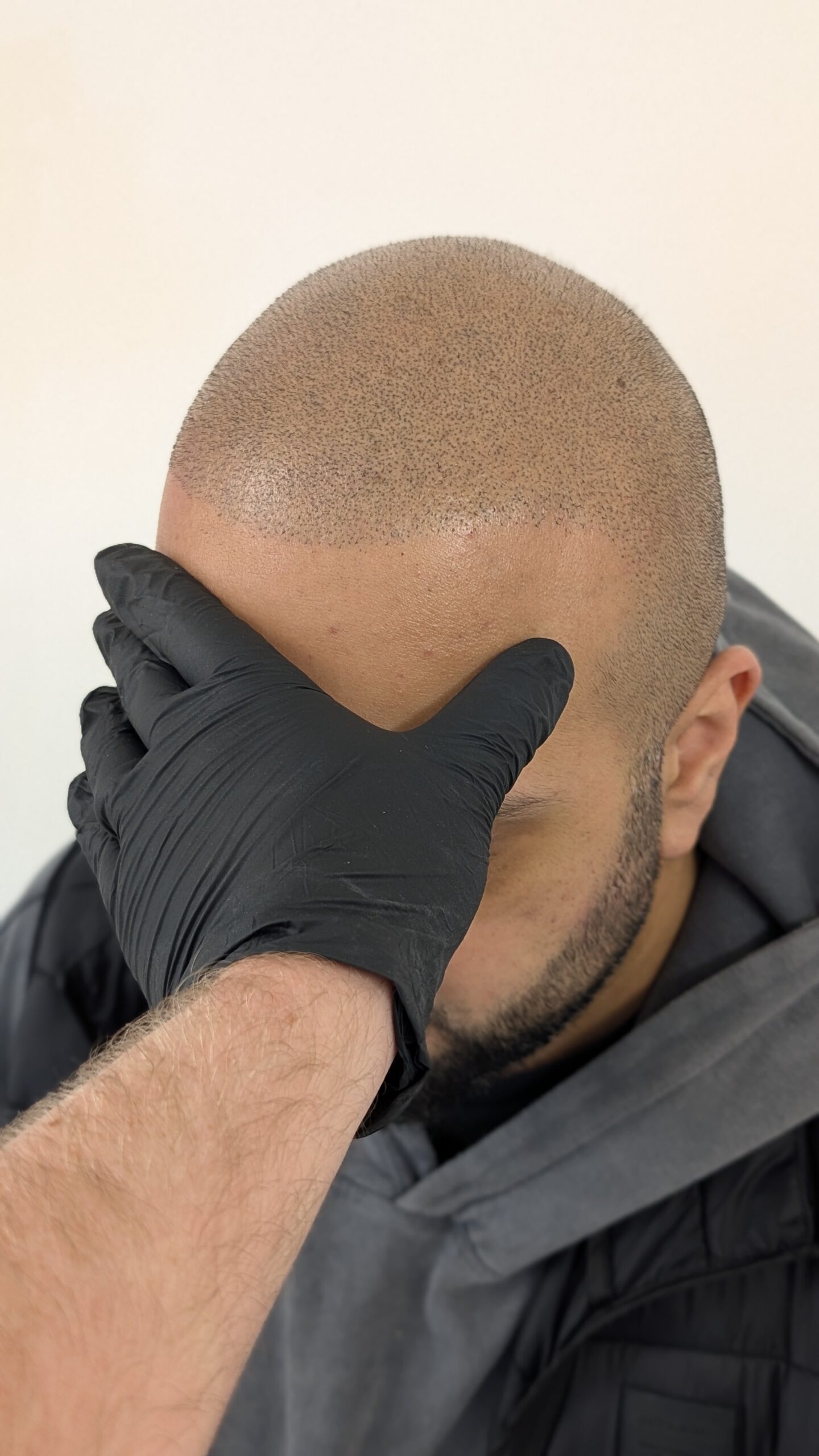 scalp micropigmentation safety