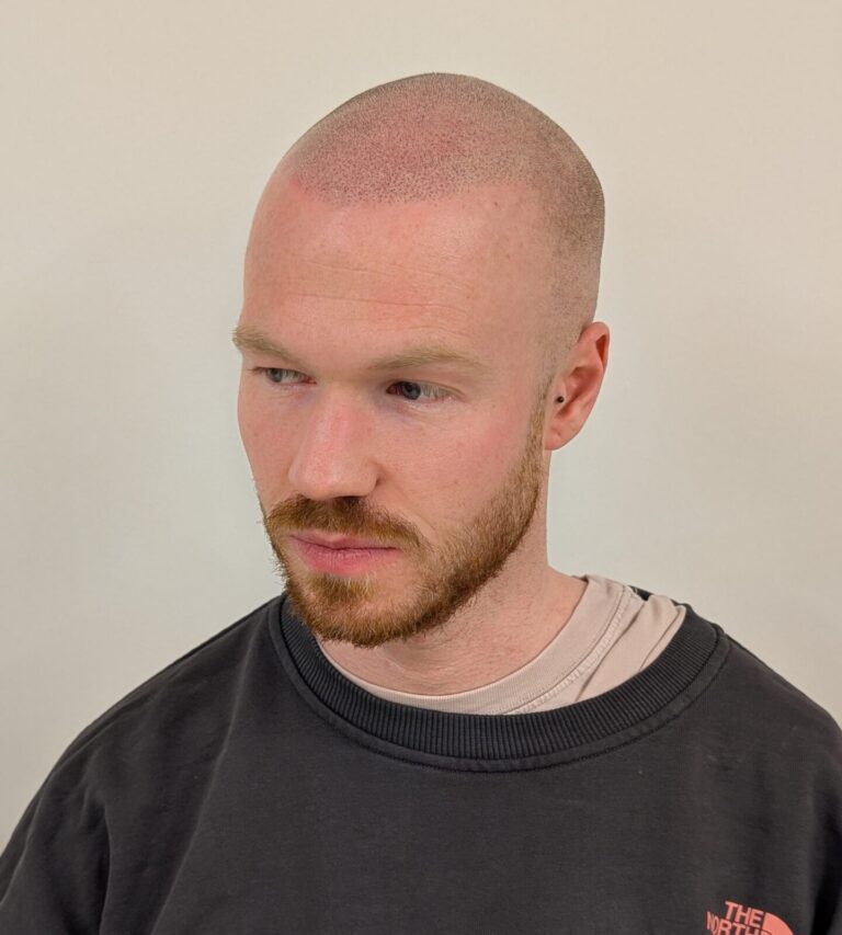 what is scalp micropigmentation? Alex James Clinic Lancashire