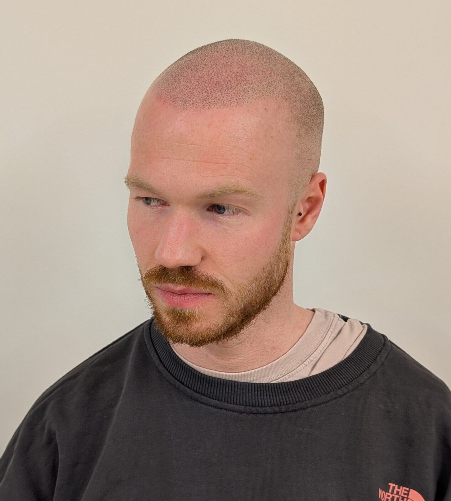 what is scalp micropigmentation? Alex James Clinic Lancashire